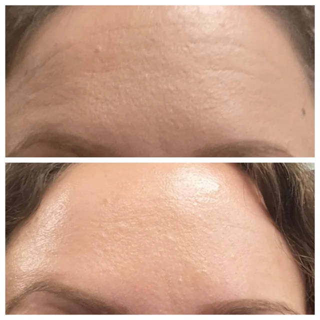 Before And After Using Tretinoin Cream